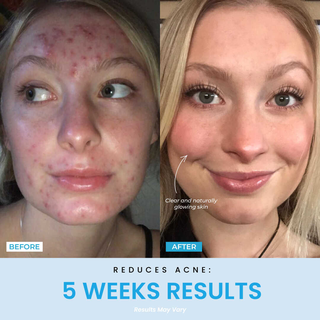 Elunori - EMS Ansiktslyft