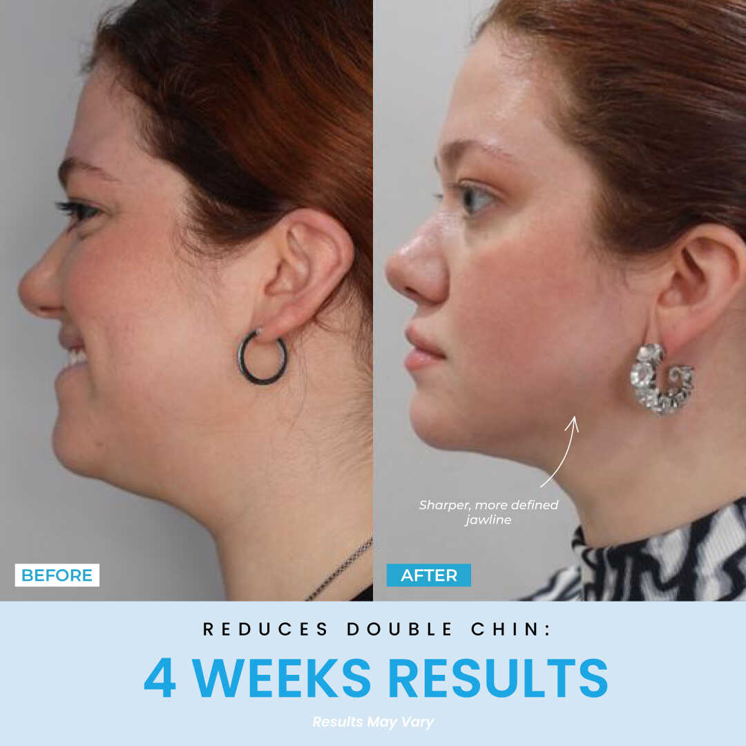 Elunori - EMS Ansiktslyft