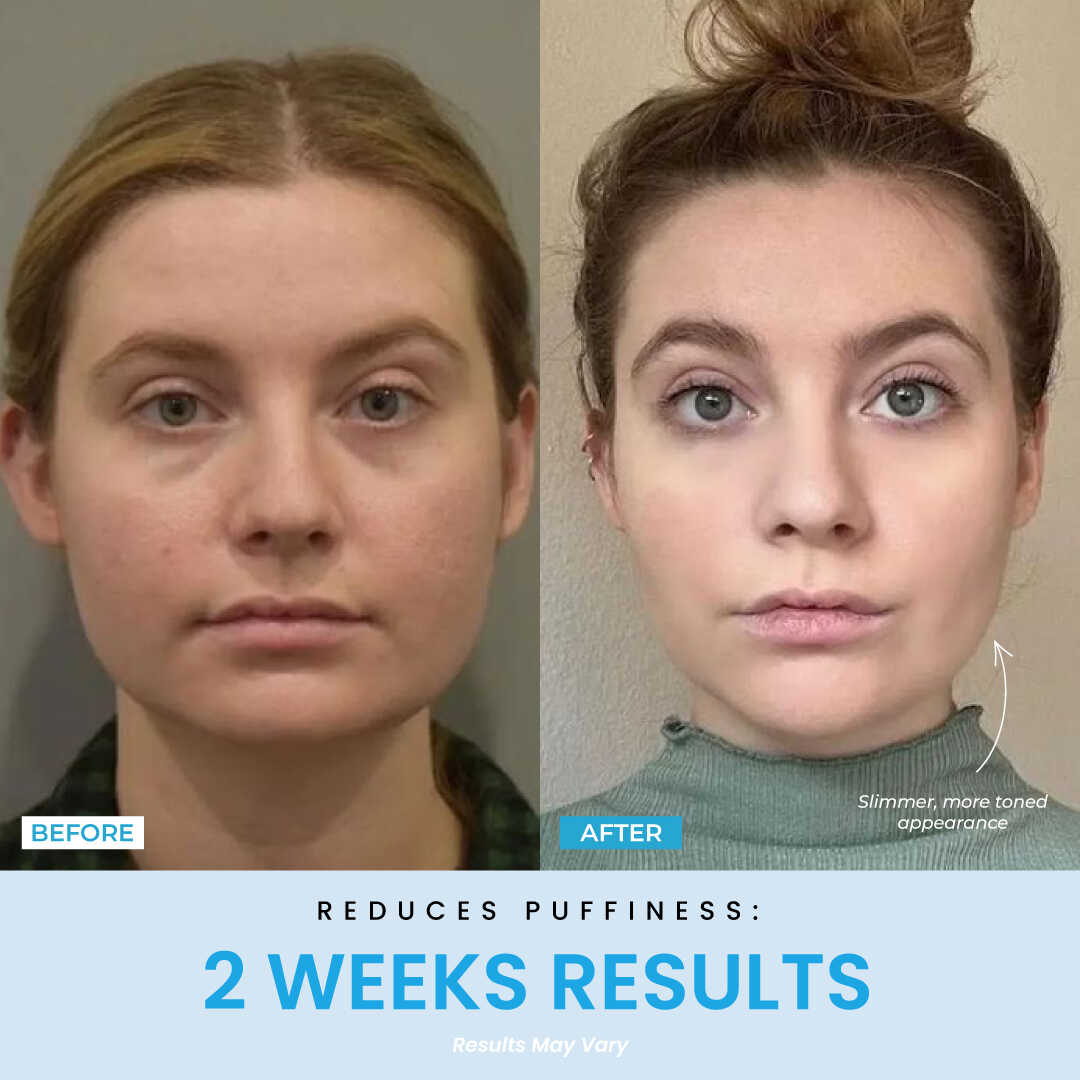 Elunori - EMS Ansiktslyft