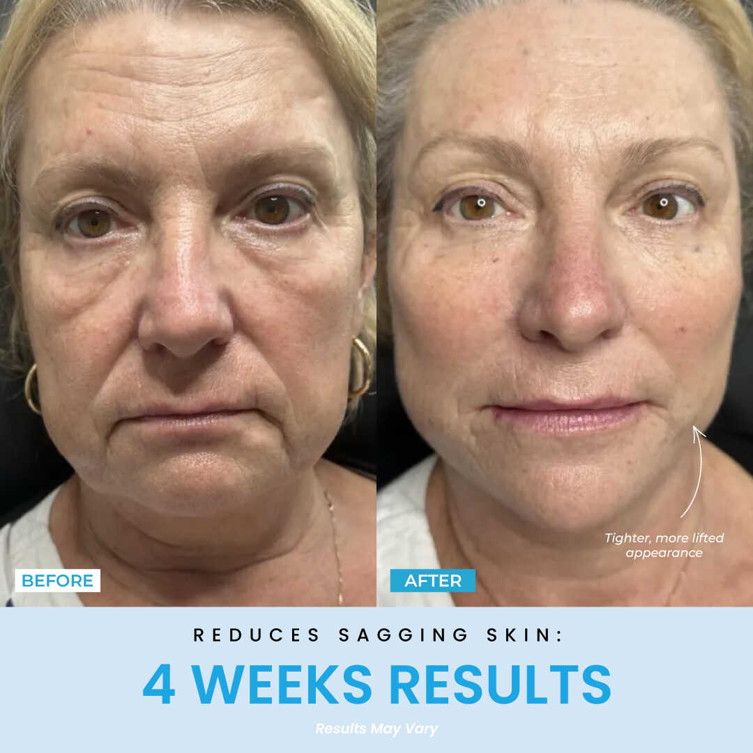 Elunori - EMS Ansiktslyft