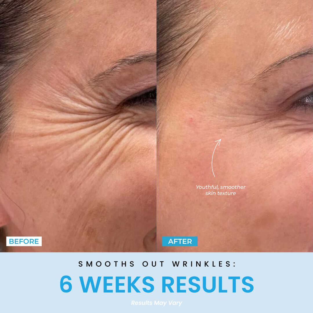 Elunori - EMS Ansiktslyft